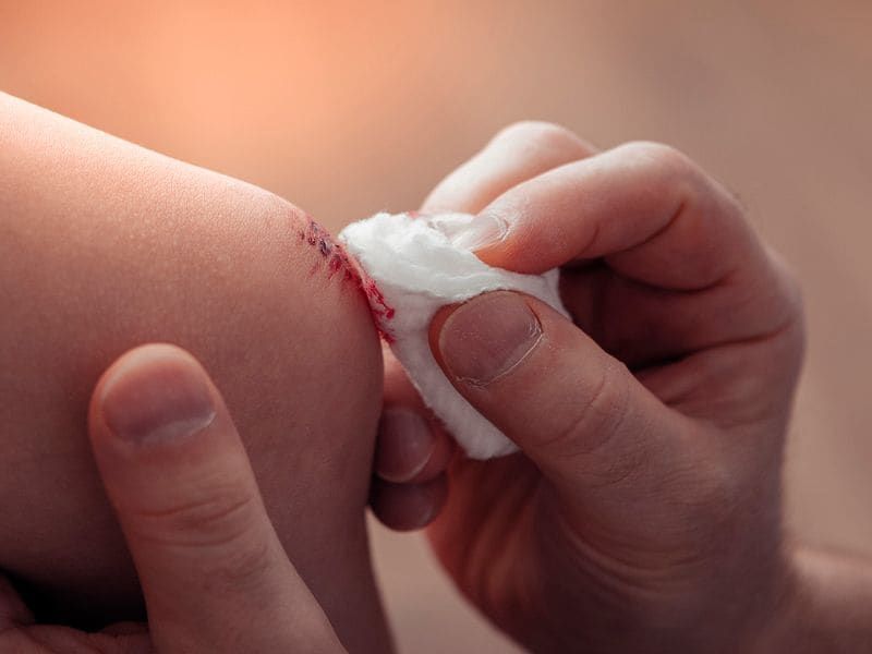 Curas de heridas, lesiones y escaras a domicilio en Granada por enfermero colegiado
